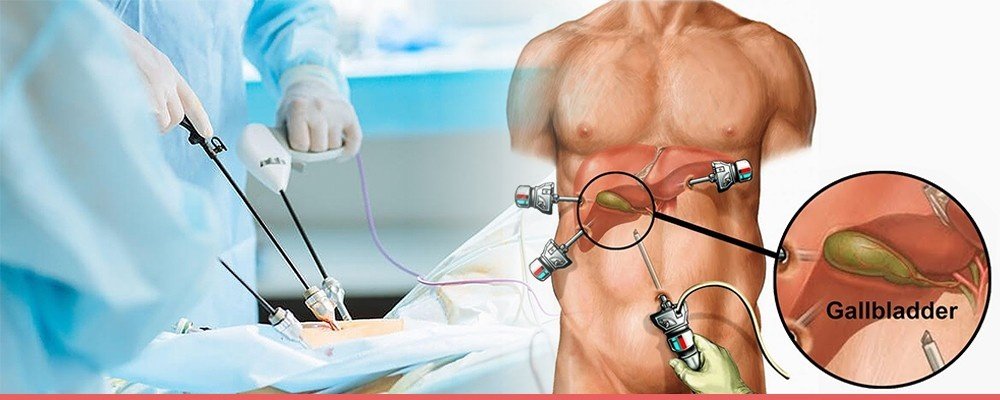 Best Laparoscopic Gallstone Surgery in Dwarka