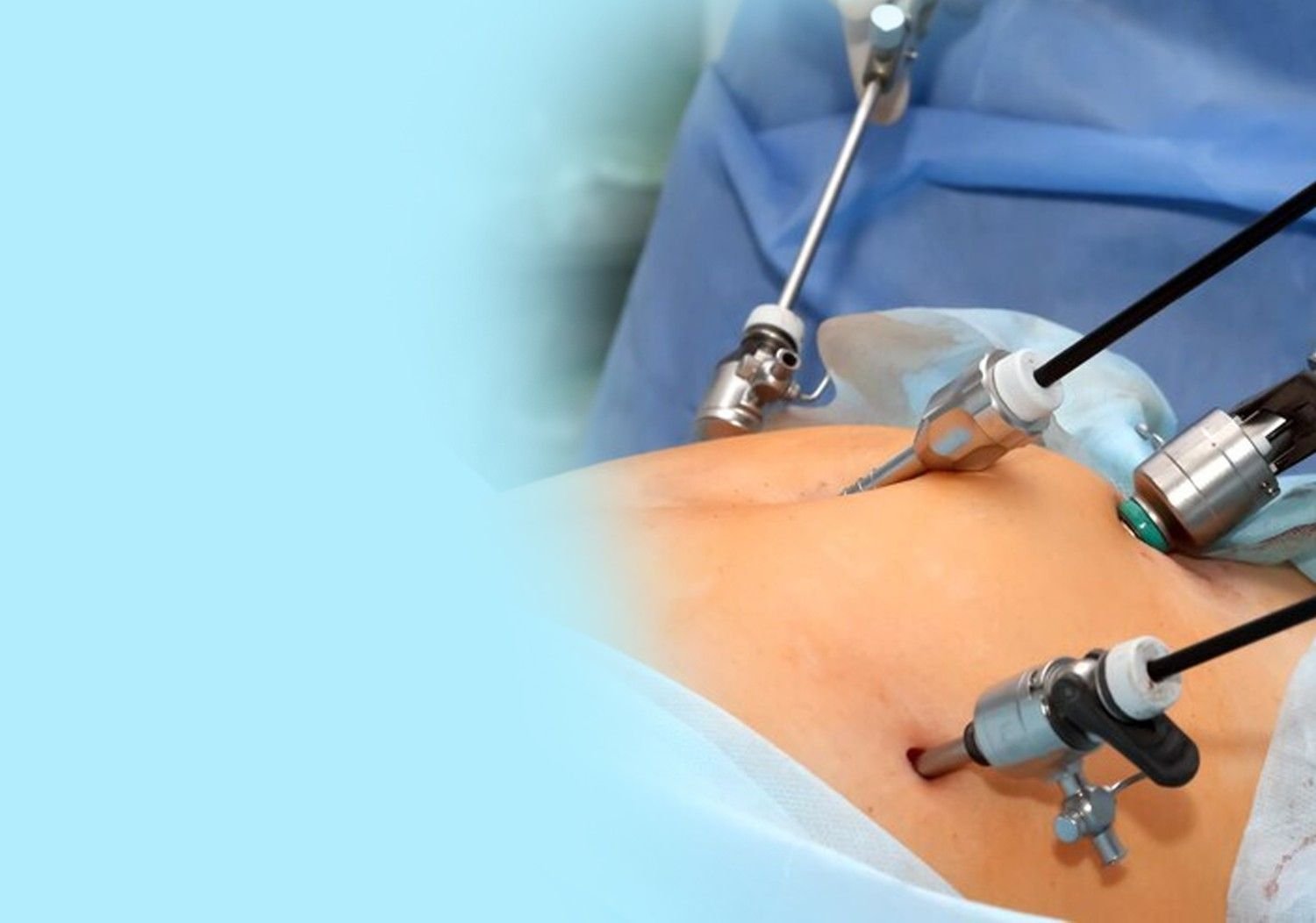 Best Laparoscopic Surgery in Vikaspuri