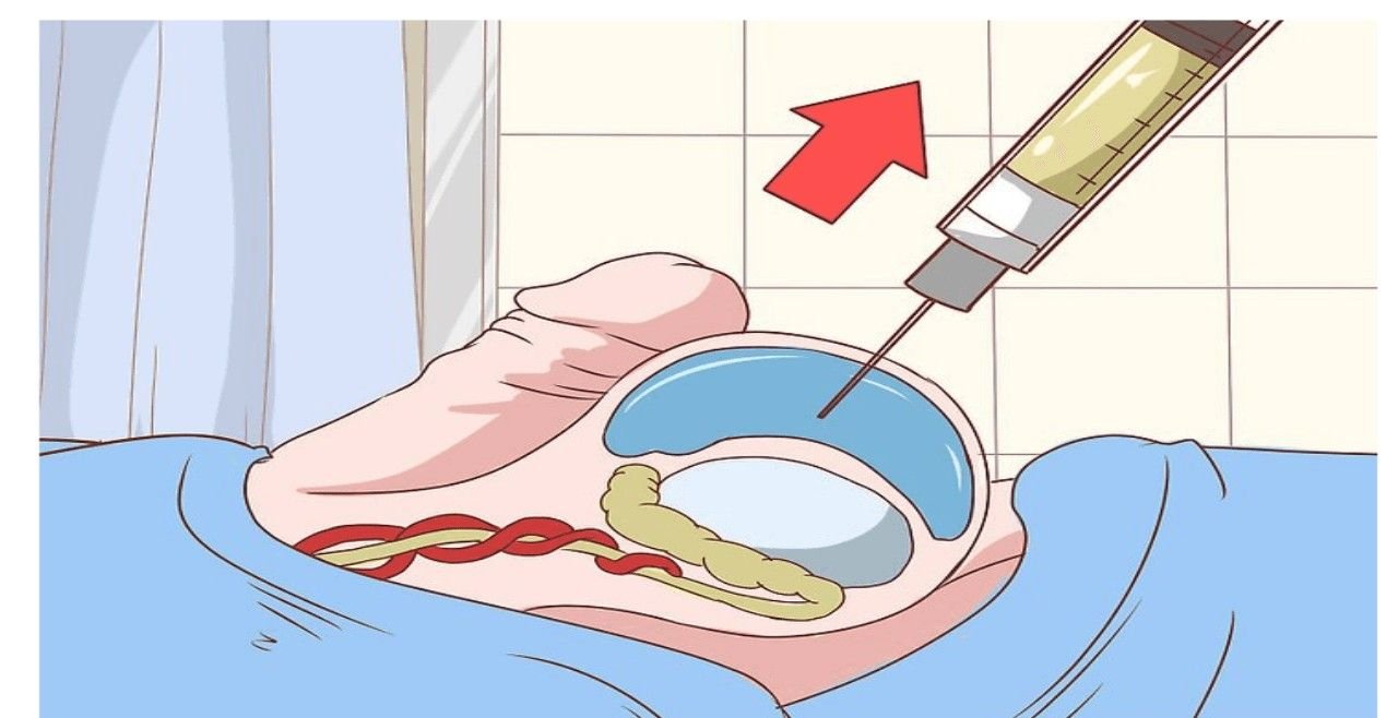 Best Hydrocele Surgery in New Delhi