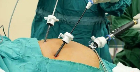 Best Gallstone Surgery in North Delhi