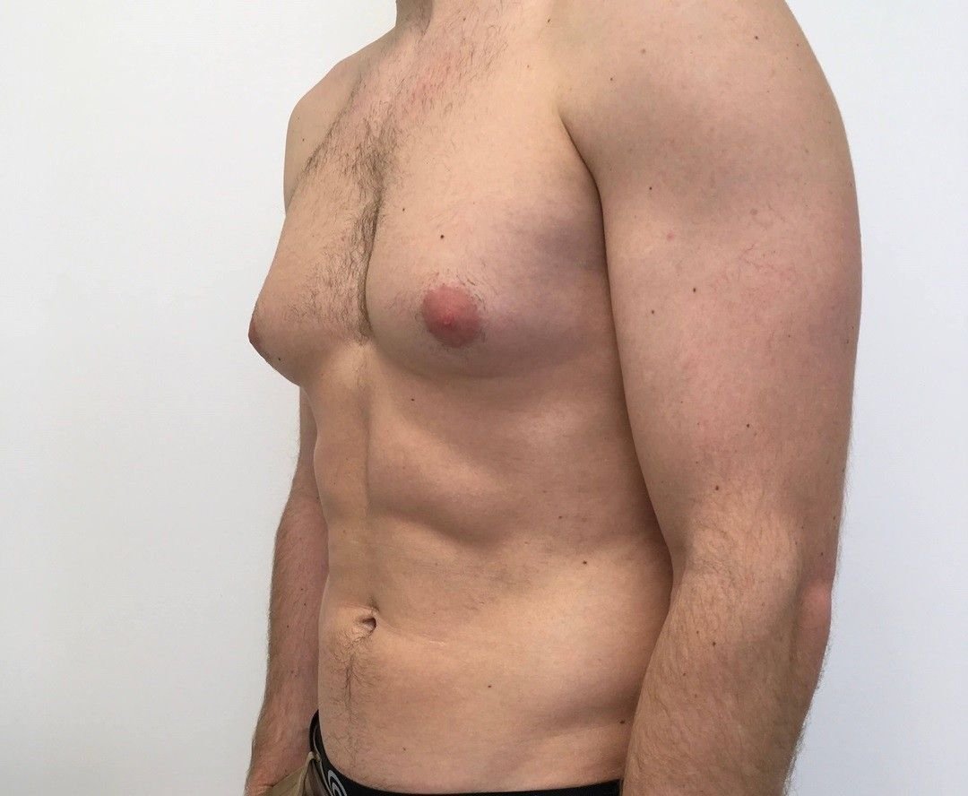 Best Gynaecomastia Surgery in North Delhi