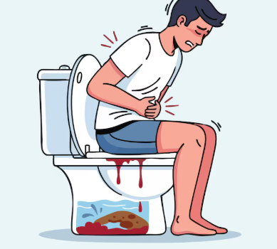 Best Stapler Piles Surgery in Delhi