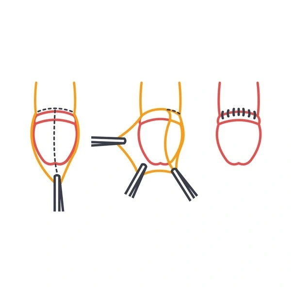 Best ZSR Circumcision in Dwarka