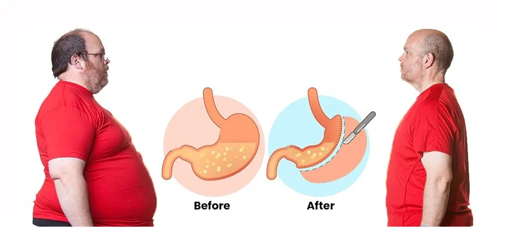 Best Bariatric Surgery in New Delhi