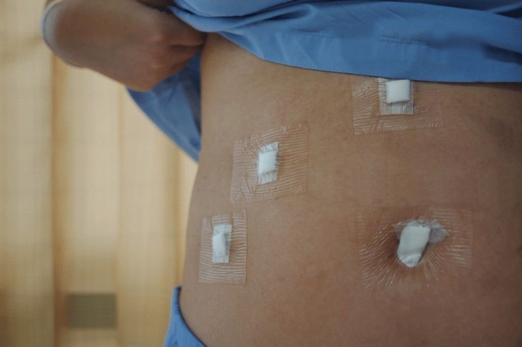 Best Laparoscopic Gallstone in Delhi NCR