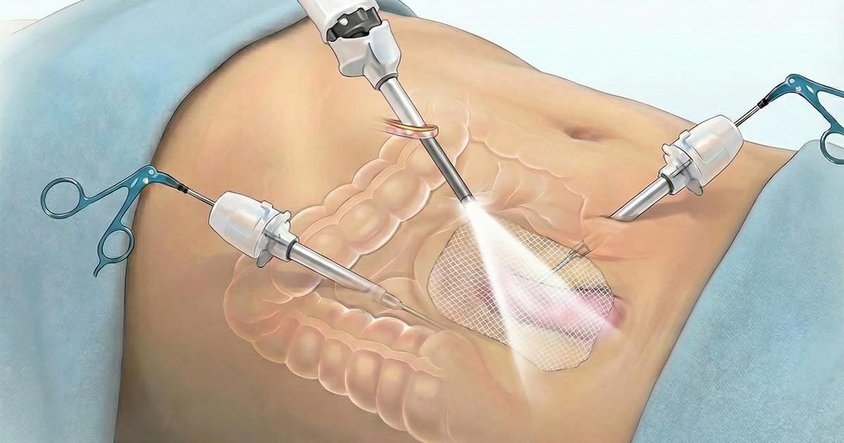 Best Laparoscopic Hernia in New Delhi