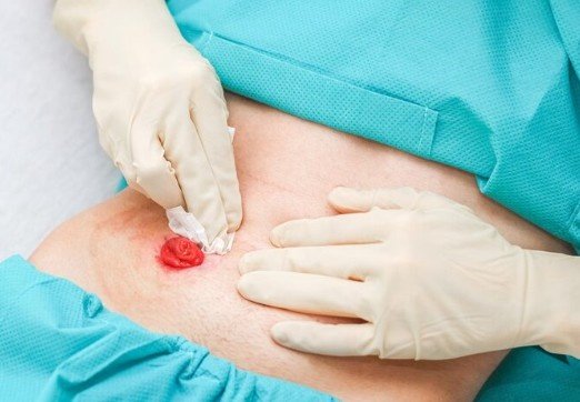 Best Cyst Surgery in Delhi