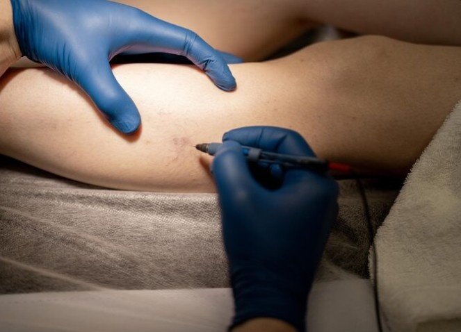 Best Lipoma Treatment in New Delhi
