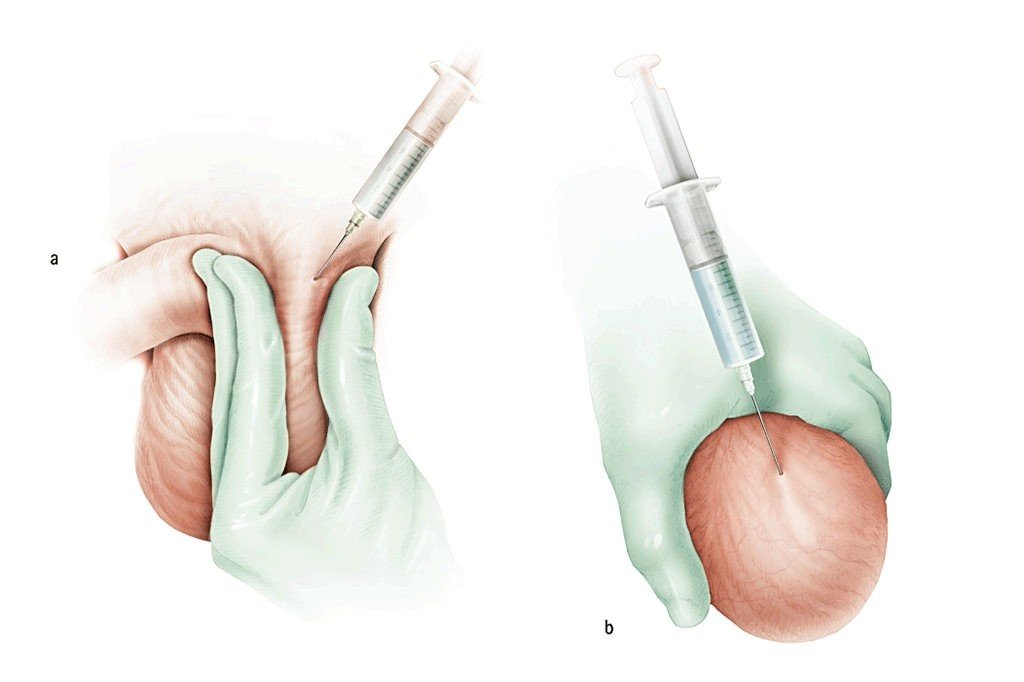 Best Hydrocele Treatment in Delhi