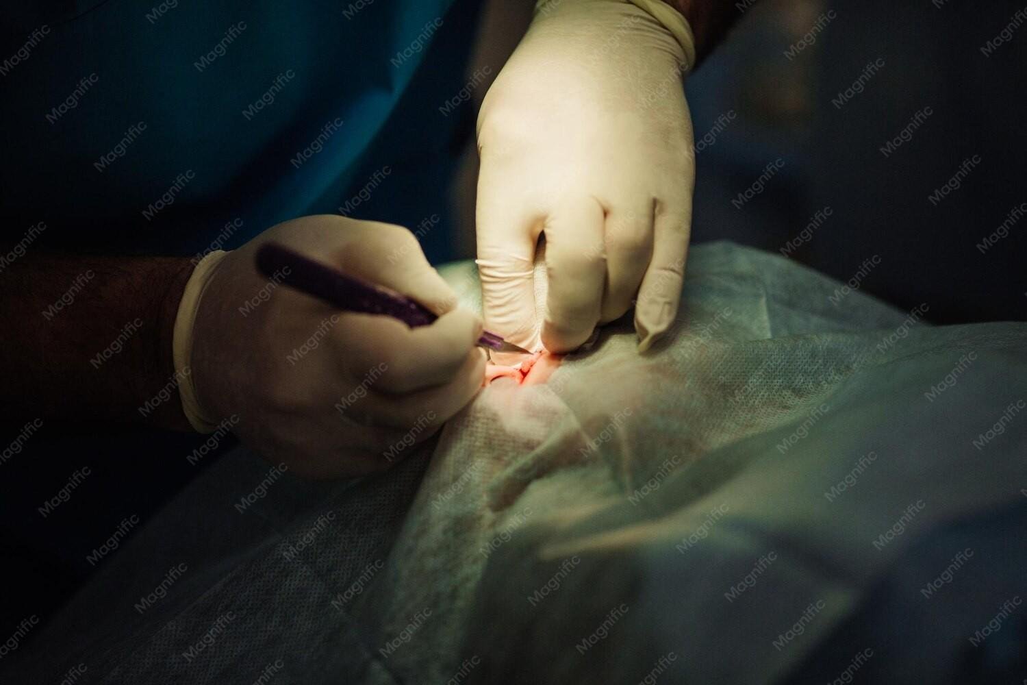 Best Fissure Surgery in Delhi