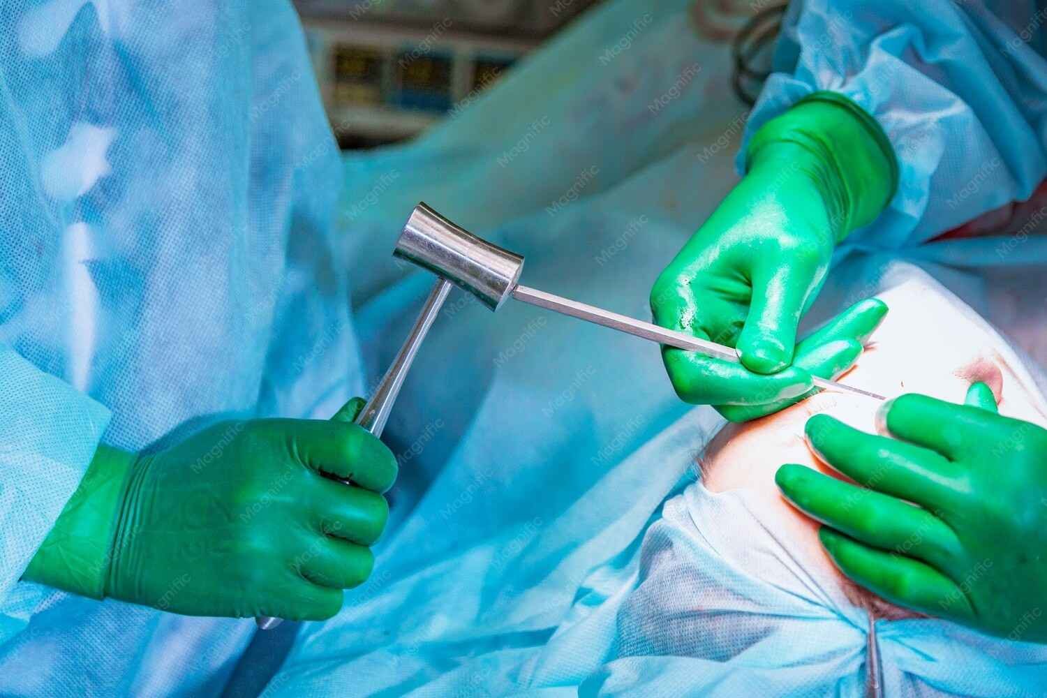 Best Laparoscopic Gallstone Surgery in Delhi