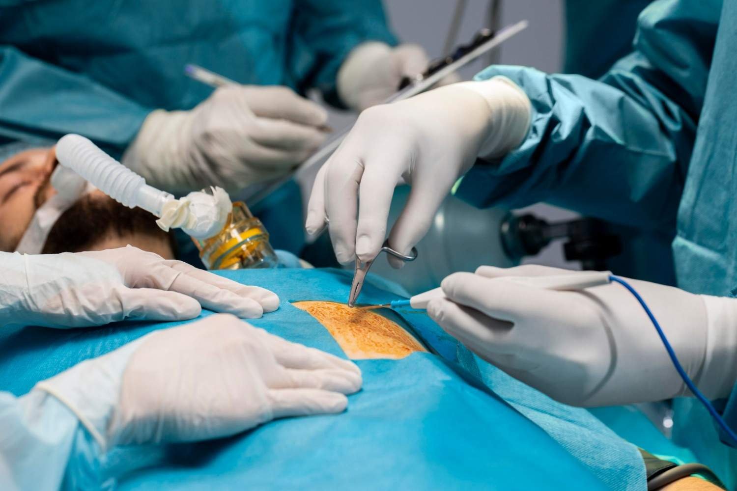 Best Laparoscopic Appendix Surgery in New Delhi