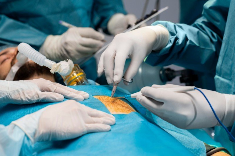 Surgeons performing minimally invasive laparoscopic appendix surgery on a patient in a modern operating room.